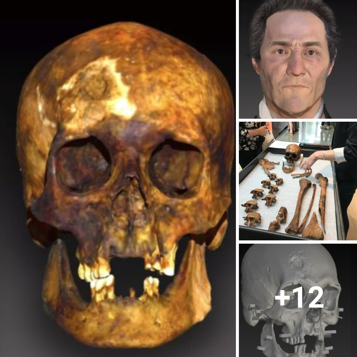 DNA Reconstruction of the Face of an Eighteenth-Century “Vampire” Buried in an Odd Way to Prevent Him From Attacking the Living